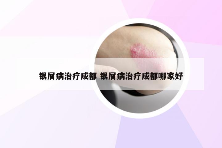 银屑病治疗成都 银屑病治疗成都哪家好