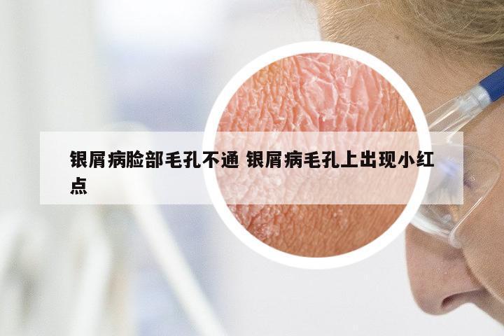 银屑病脸部毛孔不通 银屑病毛孔上出现小红点