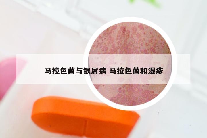 马拉色菌与银屑病 马拉色菌和湿疹