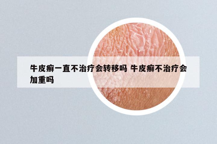 牛皮癣一直不治疗会转移吗 牛皮癣不治疗会加重吗