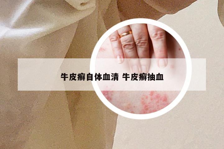 牛皮癣自体血清 牛皮癣抽血