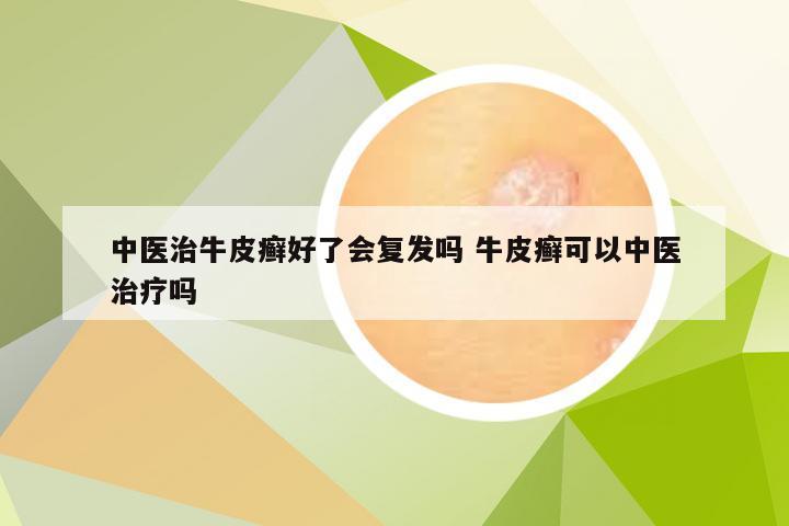 中医治牛皮癣好了会复发吗 牛皮癣可以中医治疗吗