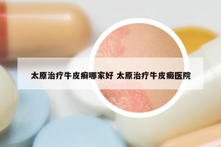 太原治疗牛皮癣哪家好 太原治疗牛皮癜医院