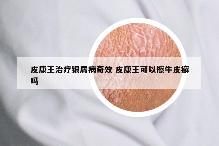 皮康王治疗银屑病奇效 皮康王可以擦牛皮癣吗