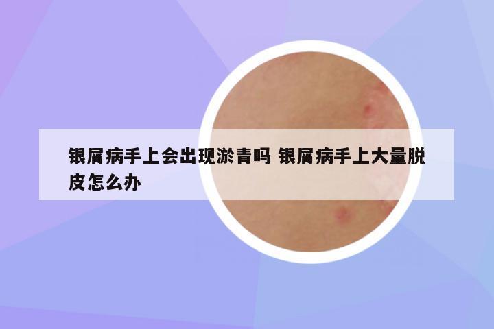 银屑病手上会出现淤青吗 银屑病手上大量脱皮怎么办