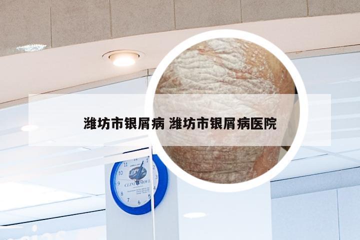 潍坊市银屑病 潍坊市银屑病医院