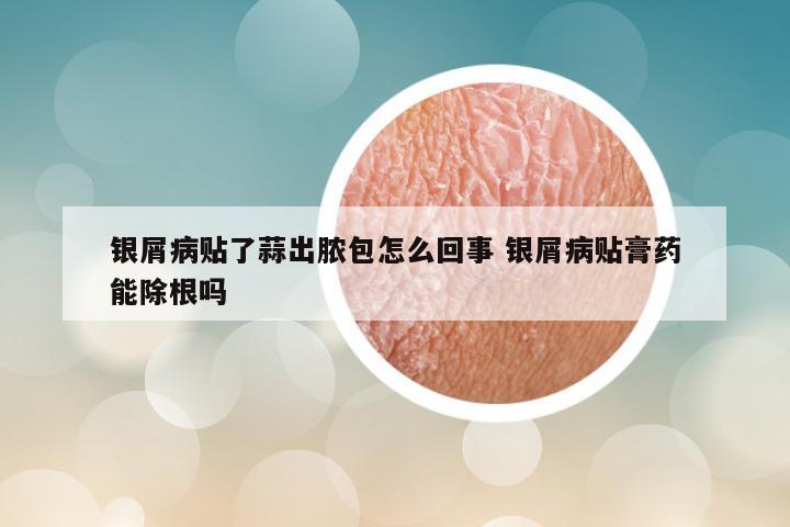 银屑病贴了蒜出脓包怎么回事 银屑病贴膏药能除根吗