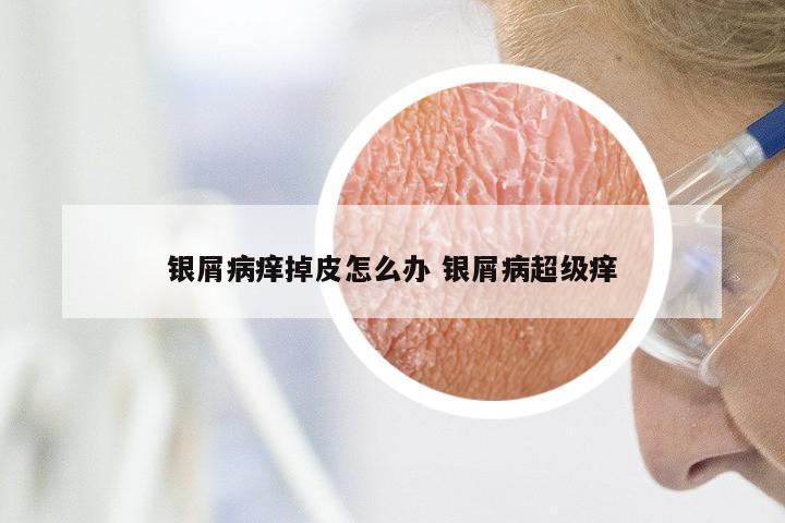银屑病痒掉皮怎么办 银屑病超级痒