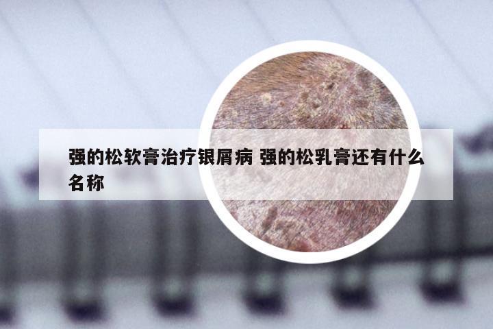 强的松软膏治疗银屑病 强的松乳膏还有什么名称