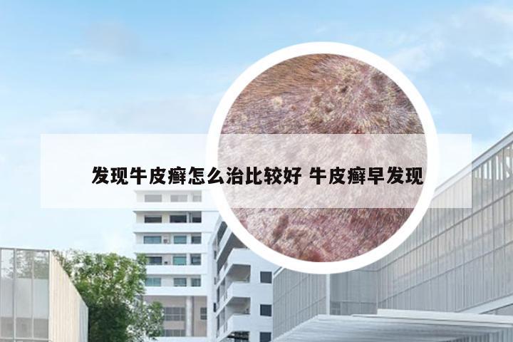 发现牛皮癣怎么治比较好 牛皮癣早发现