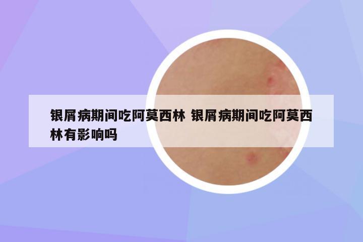 银屑病期间吃阿莫西林 银屑病期间吃阿莫西林有影响吗