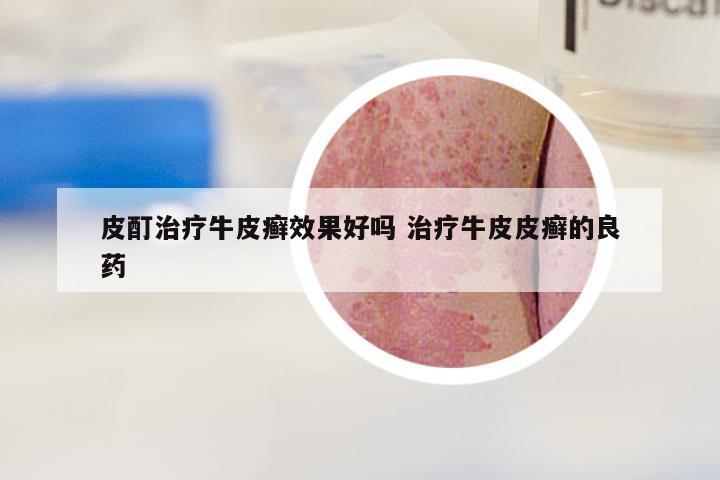 皮酊治疗牛皮癣效果好吗 治疗牛皮皮癣的良药