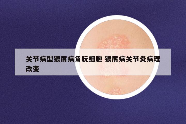关节病型银屑病角朊细胞 银屑病关节炎病理改变