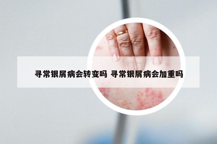 寻常银屑病会转变吗 寻常银屑病会加重吗