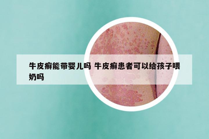 牛皮癣能带婴儿吗 牛皮癣患者可以给孩子喂奶吗