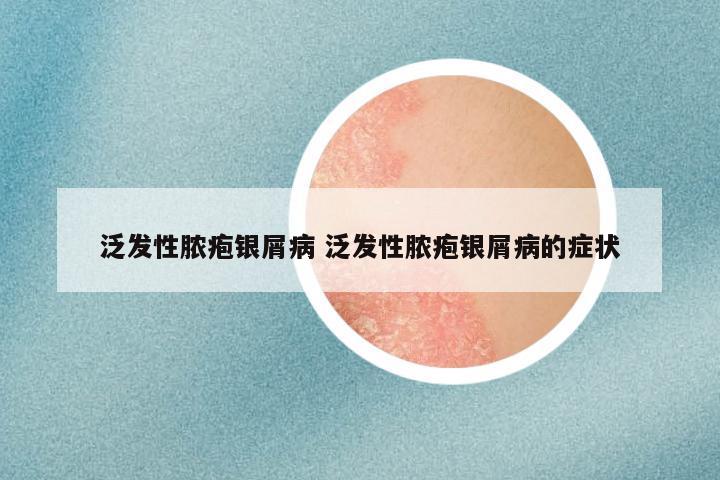 泛发性脓疱银屑病 泛发性脓疱银屑病的症状