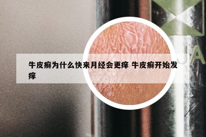 牛皮癣为什么快来月经会更痒 牛皮癣开始发痒