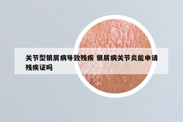 关节型银屑病导致残疾 银屑病关节炎能申请残疾证吗