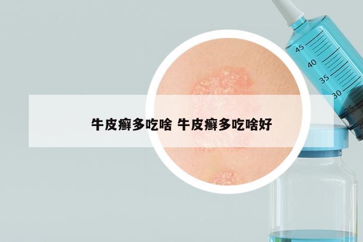 牛皮癣多吃啥 牛皮癣多吃啥好