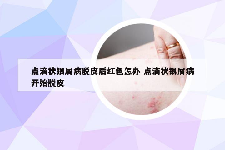 点滴状银屑病脱皮后红色怎办 点滴状银屑病开始脱皮