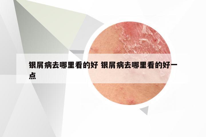 银屑病去哪里看的好 银屑病去哪里看的好一点
