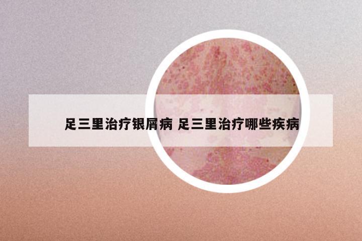 足三里治疗银屑病 足三里治疗哪些疾病