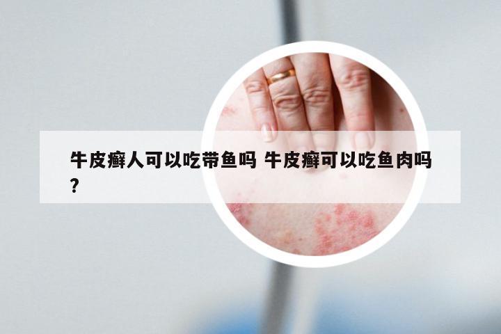 牛皮癣人可以吃带鱼吗 牛皮癣可以吃鱼肉吗?