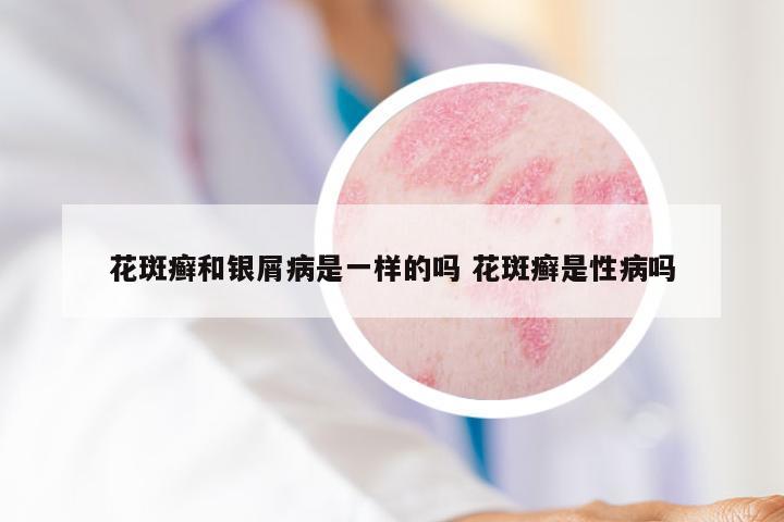 花斑癣和银屑病是一样的吗 花斑癣是性病吗