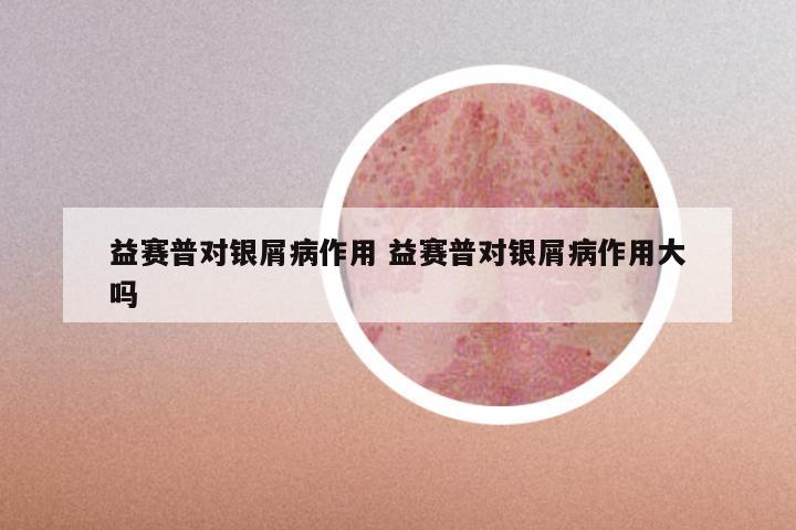 益赛普对银屑病作用 益赛普对银屑病作用大吗