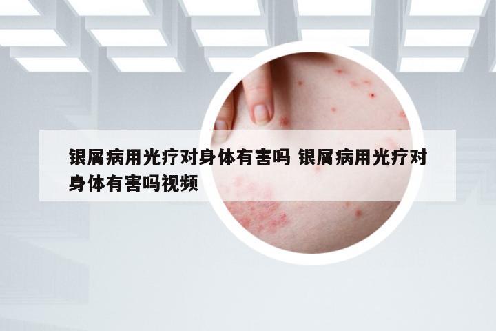 银屑病用光疗对身体有害吗 银屑病用光疗对身体有害吗视频