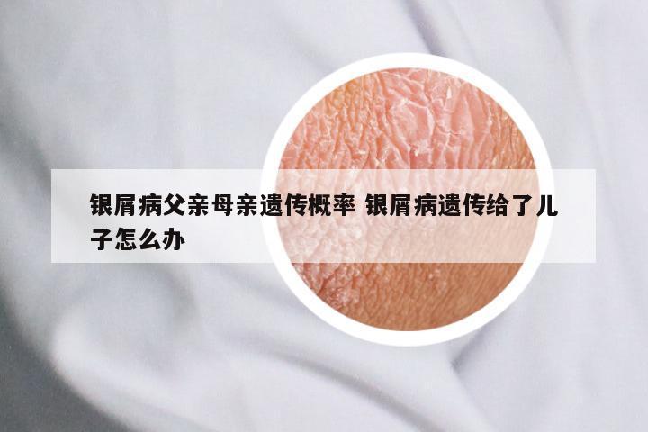 银屑病父亲母亲遗传概率 银屑病遗传给了儿子怎么办