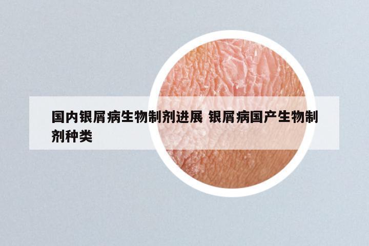国内银屑病生物制剂进展 银屑病国产生物制剂种类