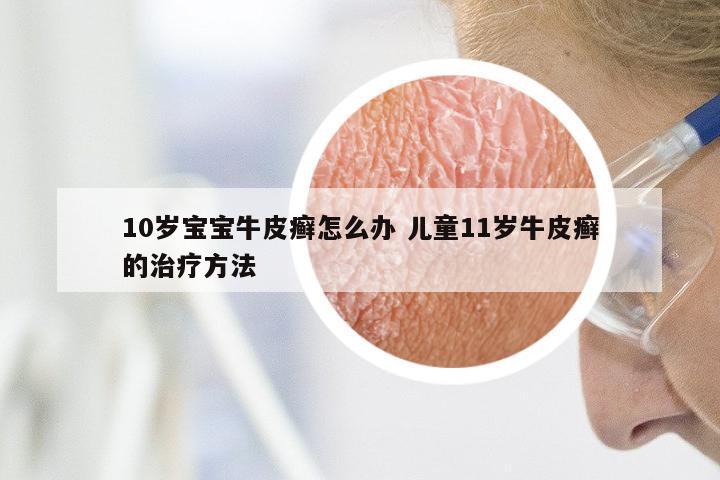 10岁宝宝牛皮癣怎么办 儿童11岁牛皮癣的治疗方法
