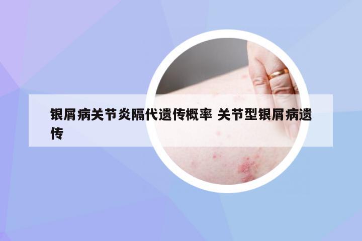 银屑病关节炎隔代遗传概率 关节型银屑病遗传