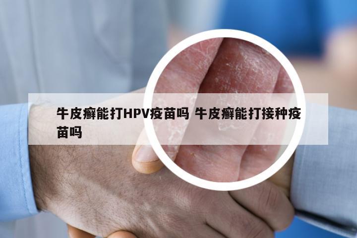 牛皮癣能打HPV疫苗吗 牛皮癣能打接种疫苗吗