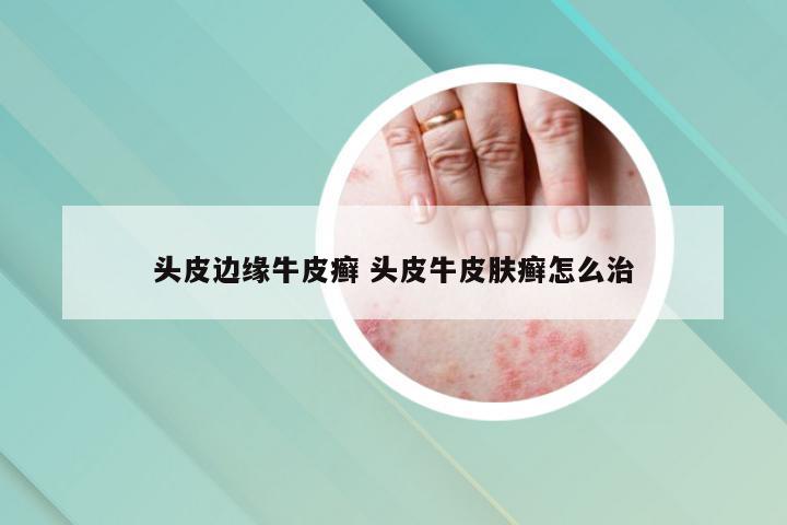 头皮边缘牛皮癣 头皮牛皮肤癣怎么治