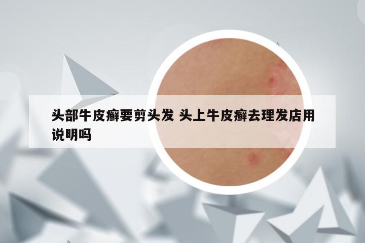 头部牛皮癣要剪头发 头上牛皮癣去理发店用说明吗