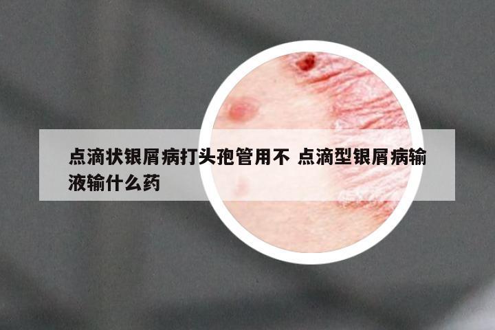 点滴状银屑病打头孢管用不 点滴型银屑病输液输什么药