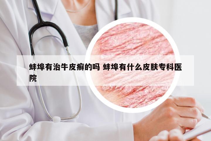 蚌埠有治牛皮癣的吗 蚌埠有什么皮肤专科医院