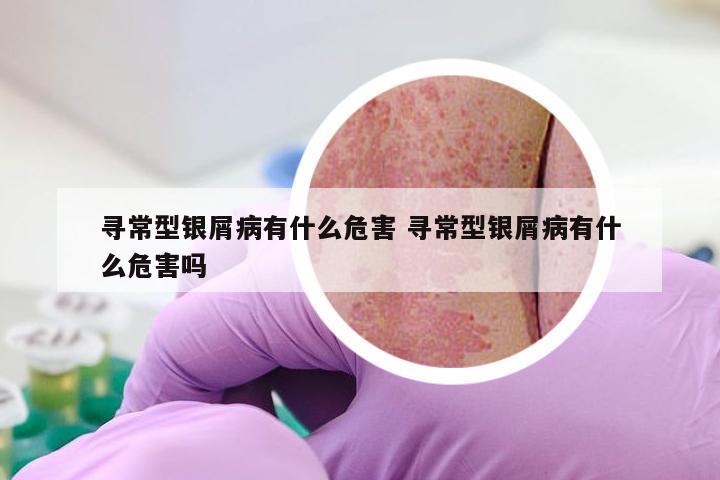 寻常型银屑病有什么危害 寻常型银屑病有什么危害吗