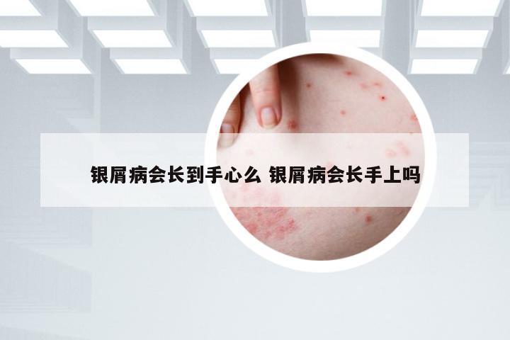 银屑病会长到手心么 银屑病会长手上吗