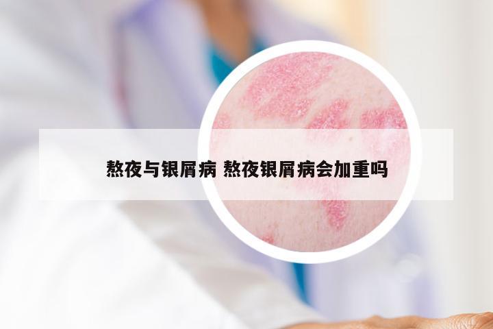 熬夜与银屑病 熬夜银屑病会加重吗