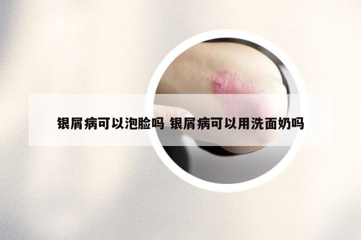 银屑病可以泡脸吗 银屑病可以用洗面奶吗