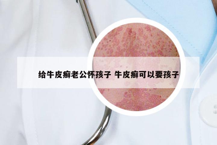 给牛皮癣老公怀孩子 牛皮癣可以要孩子