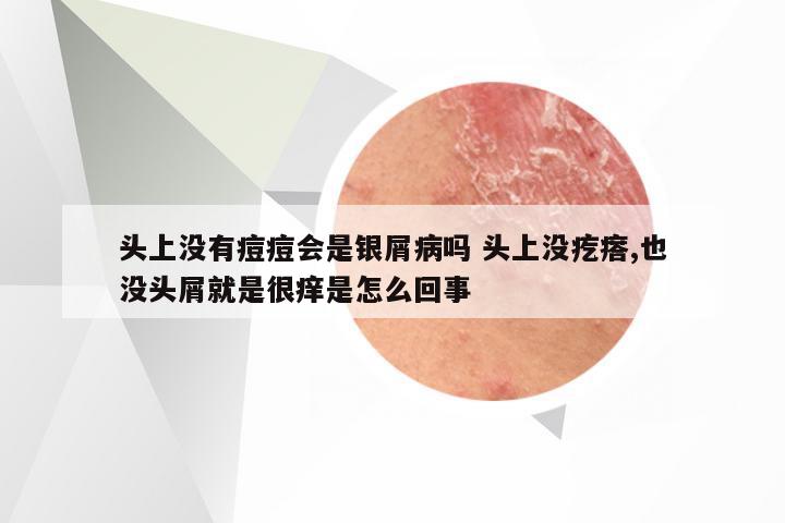头上没有痘痘会是银屑病吗 头上没疙瘩,也没头屑就是很痒是怎么回事