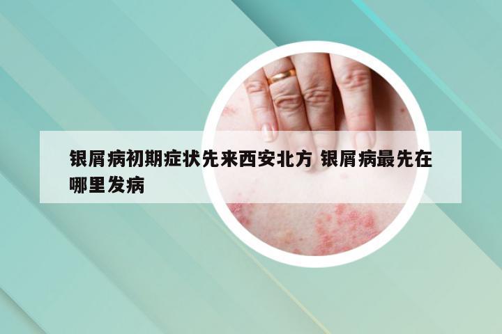 银屑病初期症状先来西安北方 银屑病最先在哪里发病