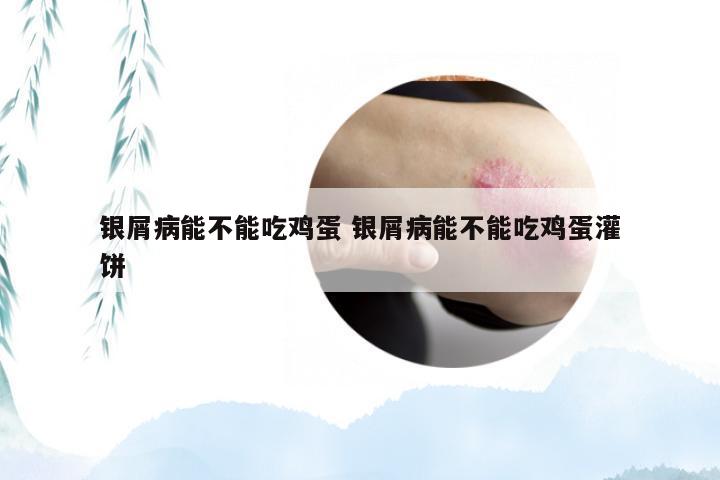 银屑病能不能吃鸡蛋 银屑病能不能吃鸡蛋灌饼