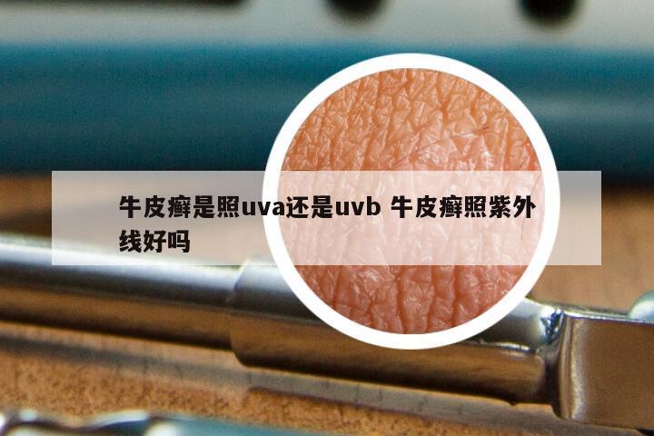 牛皮癣是照uva还是uvb 牛皮癣照紫外线好吗