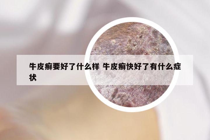 牛皮癣要好了什么样 牛皮癣快好了有什么症状