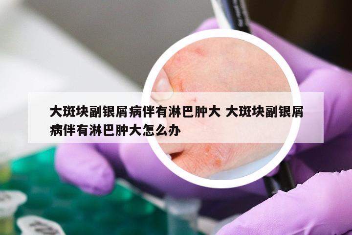 大斑块副银屑病伴有淋巴肿大 大斑块副银屑病伴有淋巴肿大怎么办